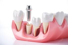 A model showing a single dental implant supporting a natural-looking crown.