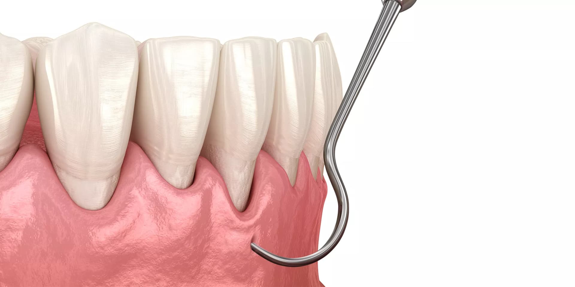 An illustration showing the Pinhole Surgical Technique as a receding gums treatment.