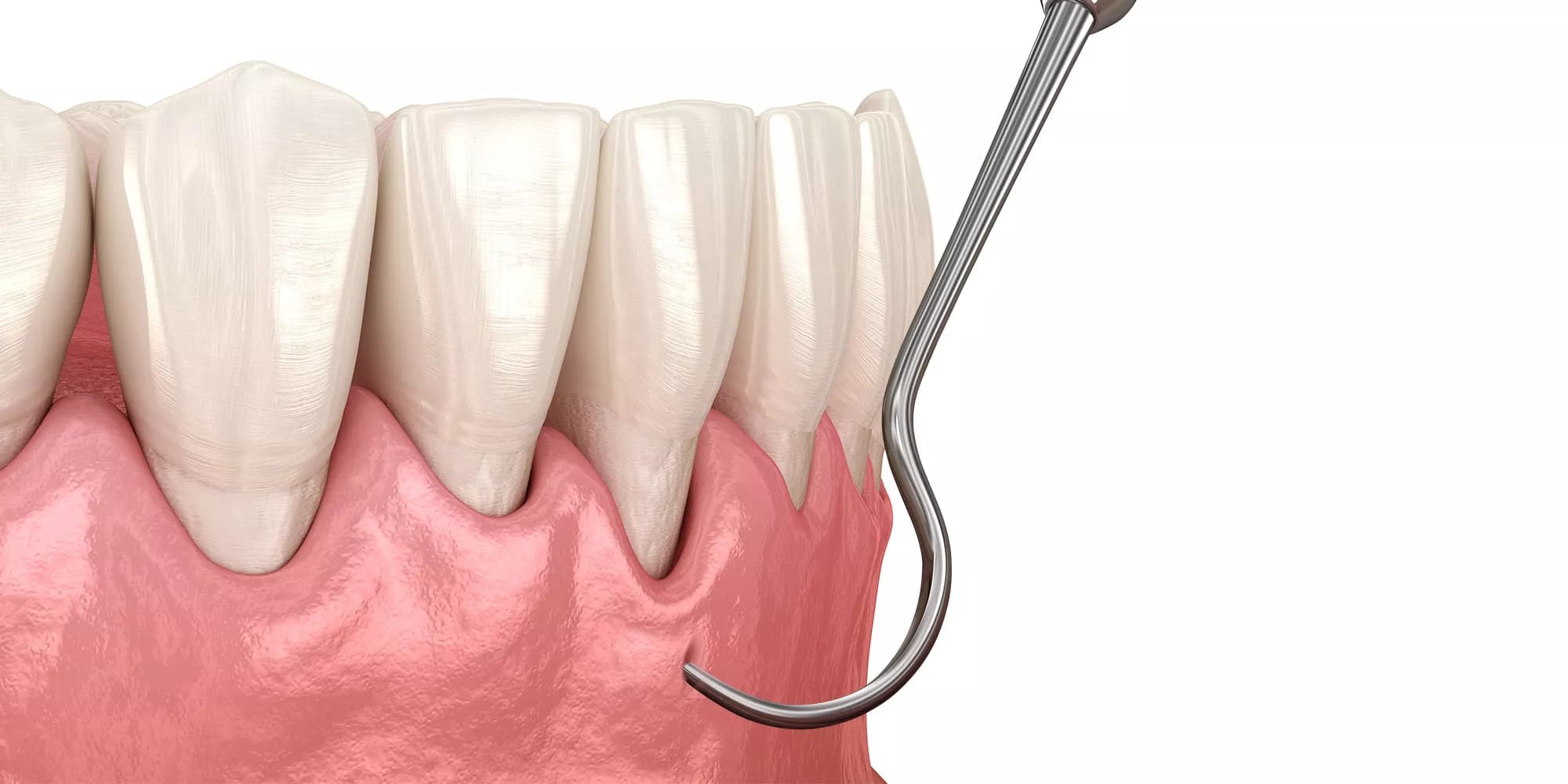 Diagram of the Pinhole Surgical Technique for treating gum recession.