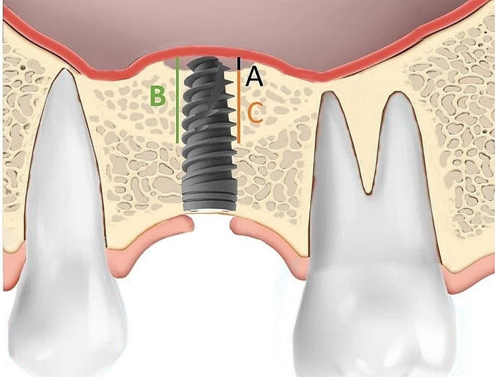 A diagram of a dental sinus lift procedure.