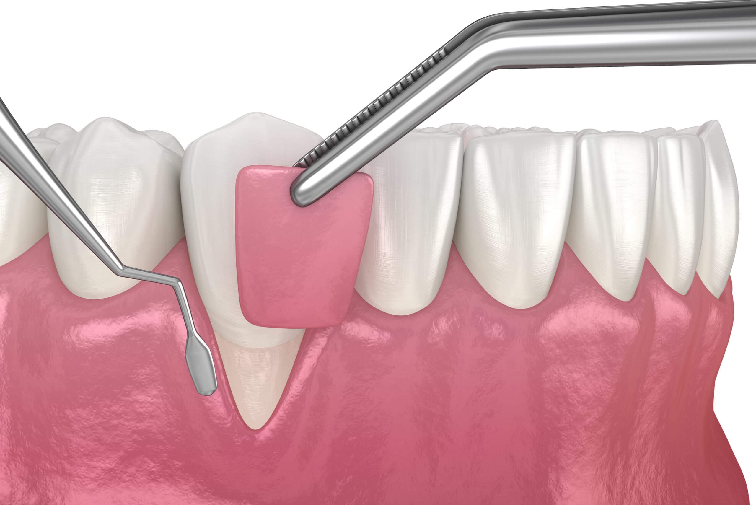 A close-up of healthy gums after a soft tissue graft procedure.