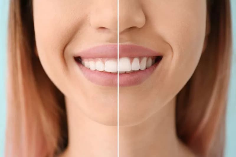 A close-up of a smile after a crown lengthening procedure.