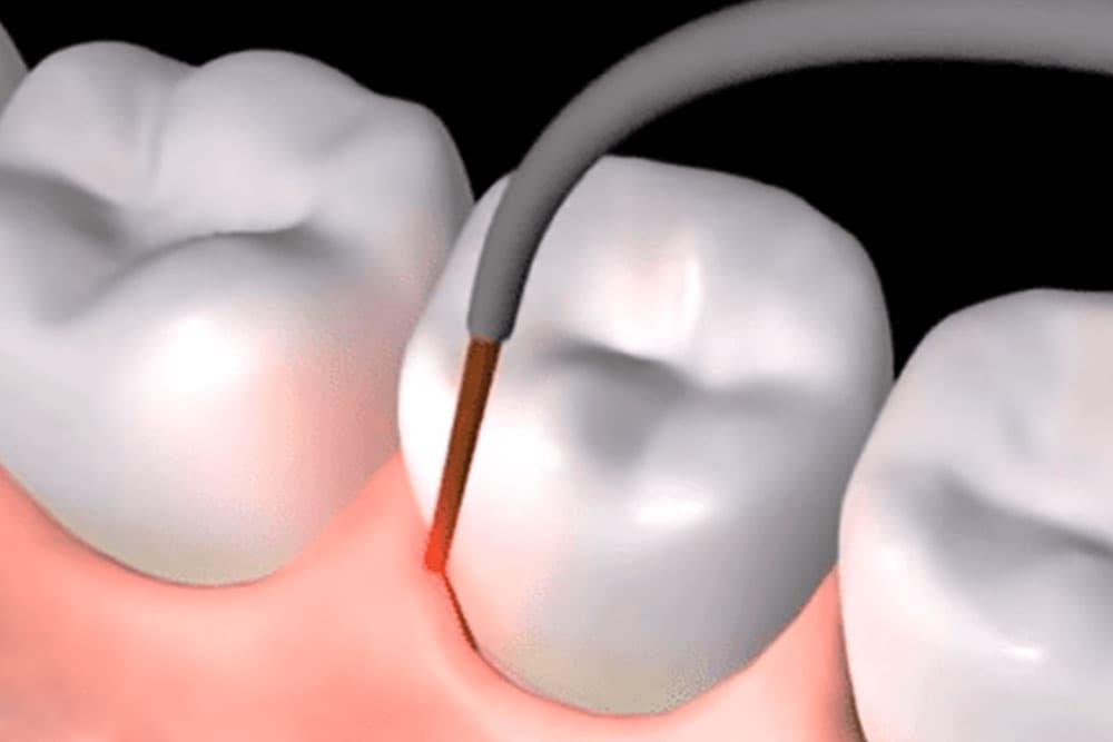 A close-up of a dentist performing the LANAP laser procedure on a patient's gums.