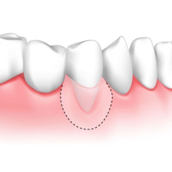 An illustration of a soft tissue graft procedure for receding gums.