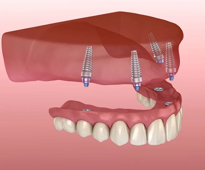 An illustration showing the All-on-4 dental implant technique with four implants supporting a full-arch prosthesis.