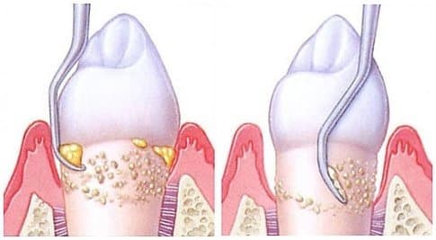 A close-up of specialized dental tools for deep cleaning on a tray.