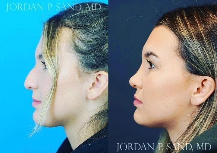 rhinoplasty surgery