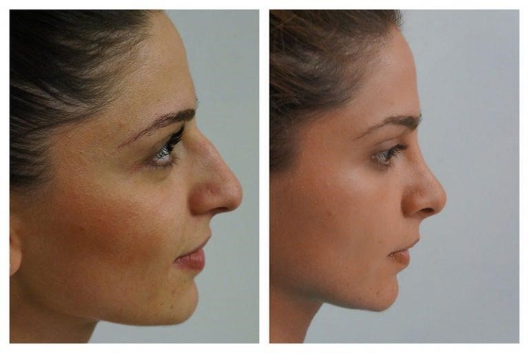 revision rhinoplasty expert los angeles