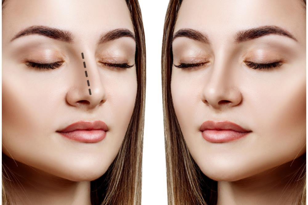 rhinoplasty surgery