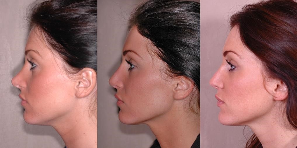 rhinoplasty surgery